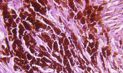 Image: Human malignant melanoma, level V, in skin cells (photo courtesy of Biodisc, Visuals Unlimited).